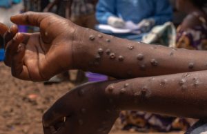 The World Health Organization has released updated clinical guidelines for managing mpox